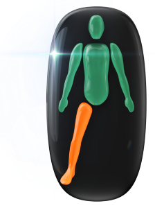 Absence of one leg, with movement in the other leg affected to a moderate level.