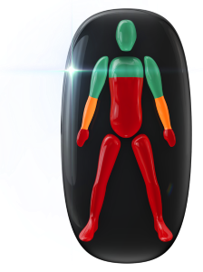 Movement affected to a high degree from the chest down and in the legs and hands, and moderately affected in the forearms.