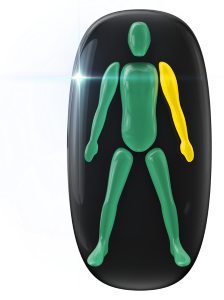 Movement and coordination mildly affected in one arm.