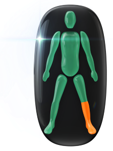 Moderately affected movement and coordination in one lower leg.