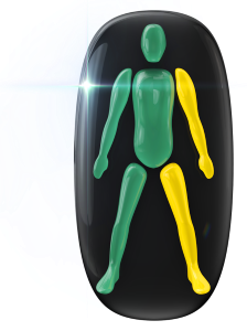 Movement mildly affected in one arm and one leg on the same side.