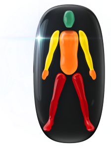 Movement in the legs highly affected, moderately affected in the trunk and hands and mildly affected in the arms.
