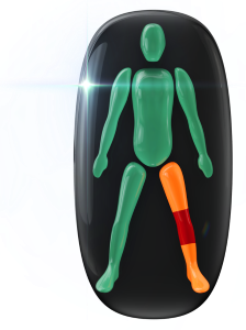 Movement and coordination of one leg moderately affected with movement of the knee in that leg highly affected.