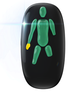 Absence of one forearm, one leg through the knee and one leg above the knee. Movement in one hand is also mildly affected.